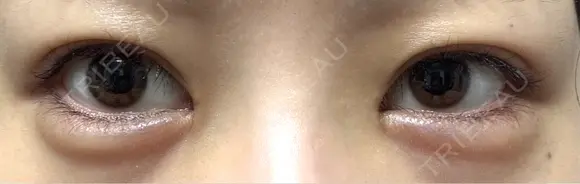 ヒアルロン酸注入（涙袋） 吉祥寺アイビークリニック DAY 3 メイン用