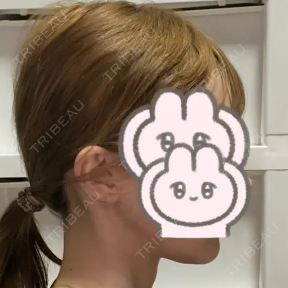 オンダリフト LIGHT CLINIC 【ライトクリニック】 名古屋院 AFTER メイン用