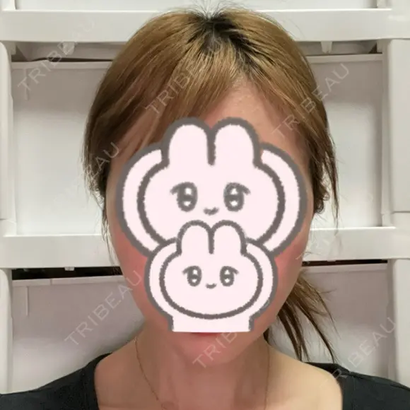 オンダリフト LIGHT CLINIC 【ライトクリニック】 名古屋院 DAY 23 メイン用