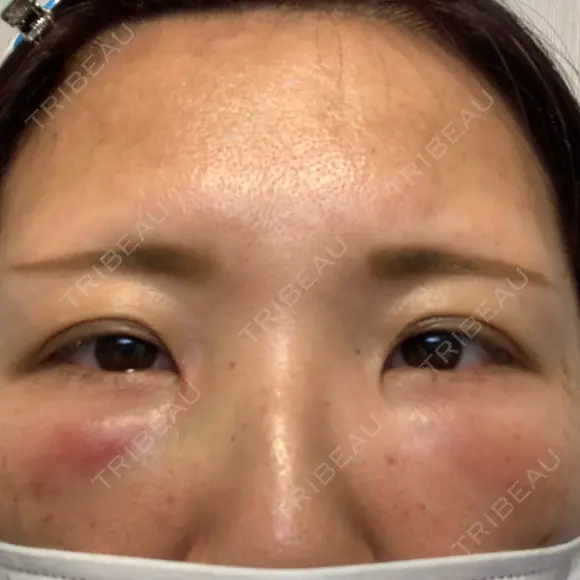 クマ治療 湘南美容クリニック 千葉センシティ院 DAY 1 メイン用