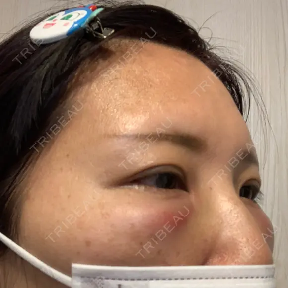 クマ治療 湘南美容クリニック 千葉センシティ院 DAY 1 メイン用