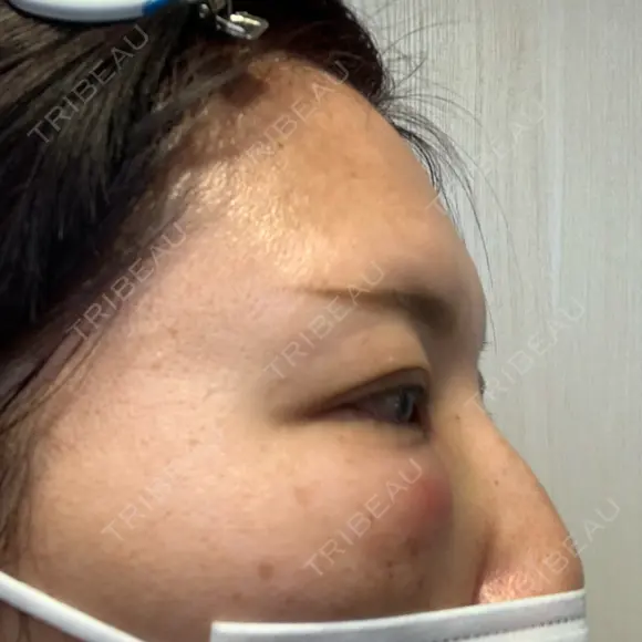 クマ治療 湘南美容クリニック 千葉センシティ院 DAY 1 メイン用