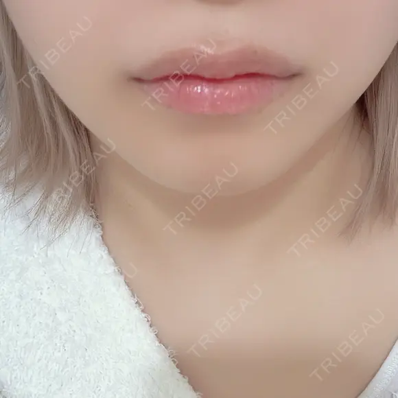 ヒアルロン酸注入（唇） / ボトックス（口角） PRO CLINIC プロクリニック 銀座院 AFTER メイン用
