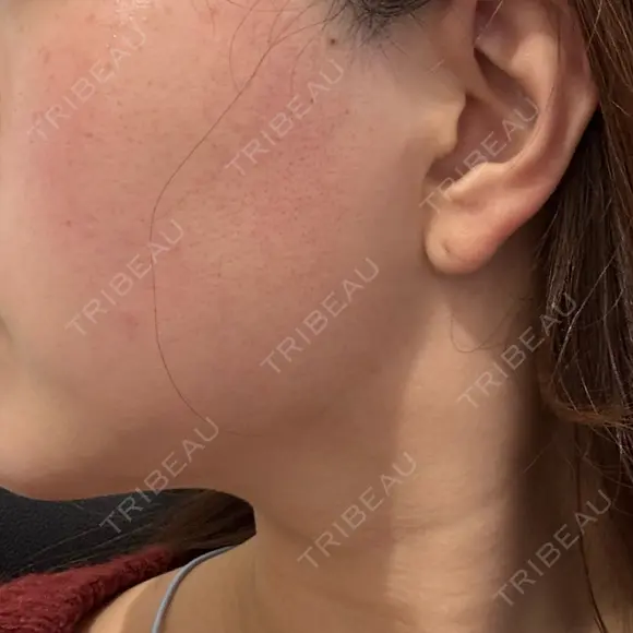 ボトックス（エラ・小顔） / ボトックス（肩） Tokyo Tensei Clinic 新宿院 AFTER メイン用