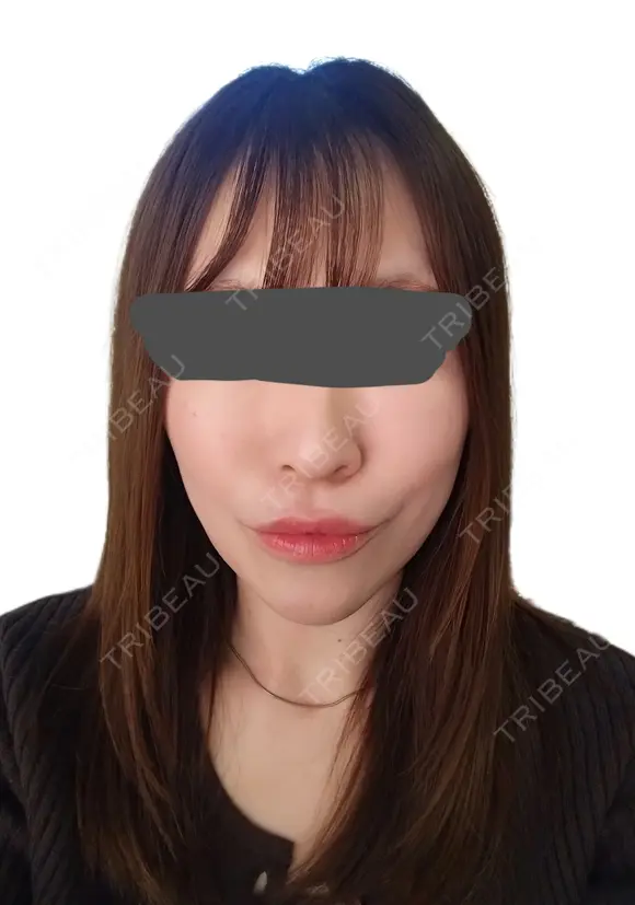 シワ取りボトックス / ピコレーザートーニング（美白・肝斑） / ピコフラクショナルレーザー（毛穴・ニキビ跡） 東京シルククリニック 東京神田院 AFTER メイン用