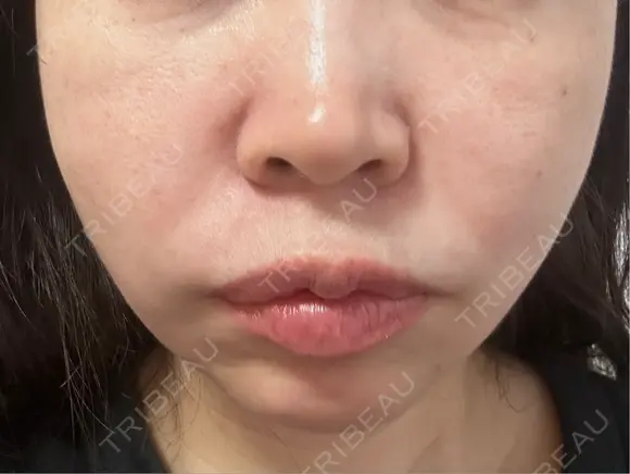 糸リフト / ボトックス（口角） 形成外科と美容外科のクリニック池袋 DAY 5 メイン用