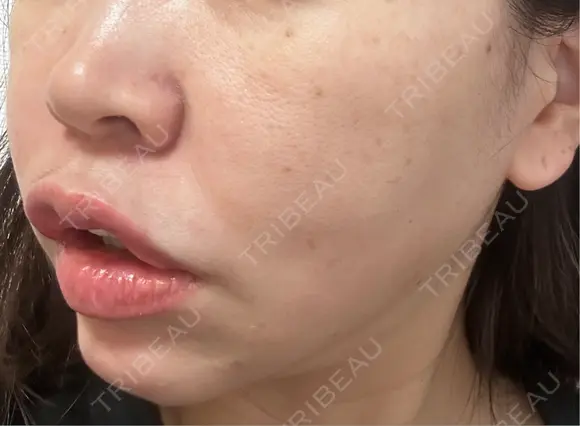 糸リフト / ボトックス（口角） 形成外科と美容外科のクリニック池袋 DAY 5 メイン用