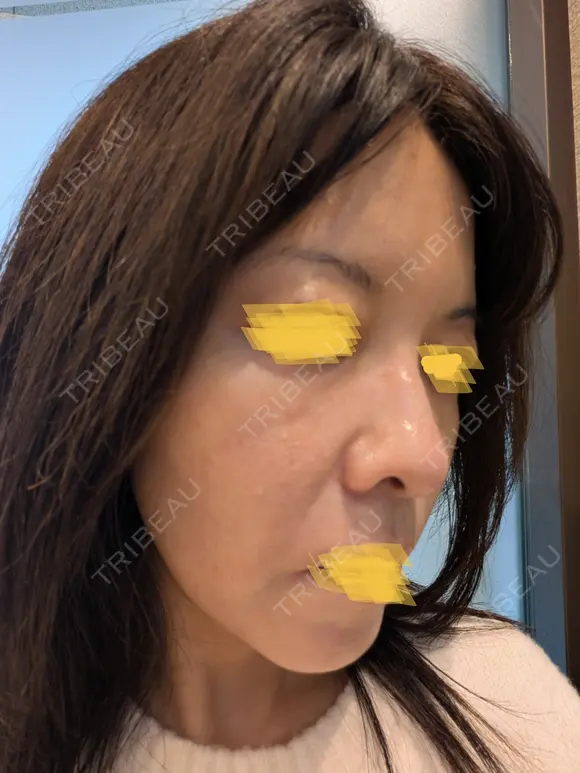 毛穴洗浄（ハイドラフェイシャルなど） Zetith Beauty Clinic 池袋院 DAY 0 メイン用