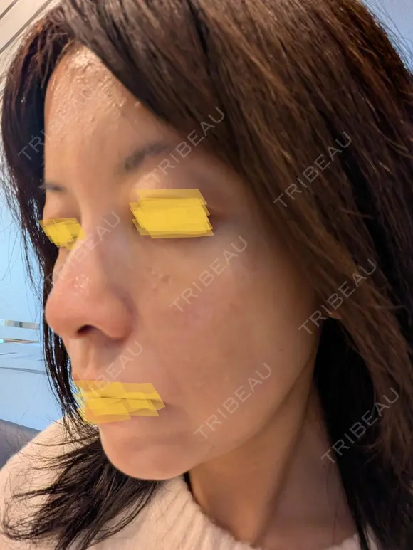 毛穴洗浄（ハイドラフェイシャルなど） Zetith Beauty Clinic 池袋院 DAY 0 メイン用