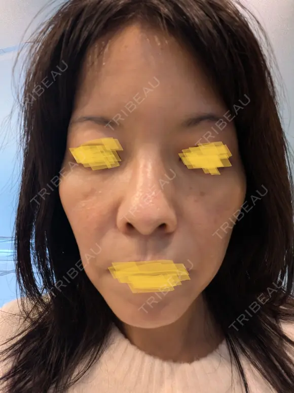 毛穴洗浄（ハイドラフェイシャルなど） Zetith Beauty Clinic 池袋院 DAY 0 メイン用