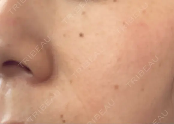 ピーリング（ニキビ・毛穴） / エレクトロポレーション / 光治療（フォトフェイシャルなど） 共立美容外科 仙台院 DAY 3 メイン用