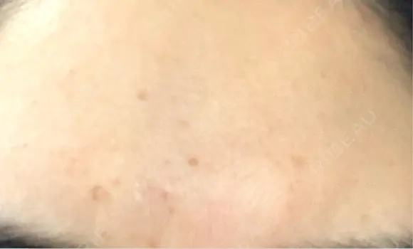 ピーリング（ニキビ・毛穴） / エレクトロポレーション / 光治療（フォトフェイシャルなど） 共立美容外科 仙台院 DAY 3 メイン用