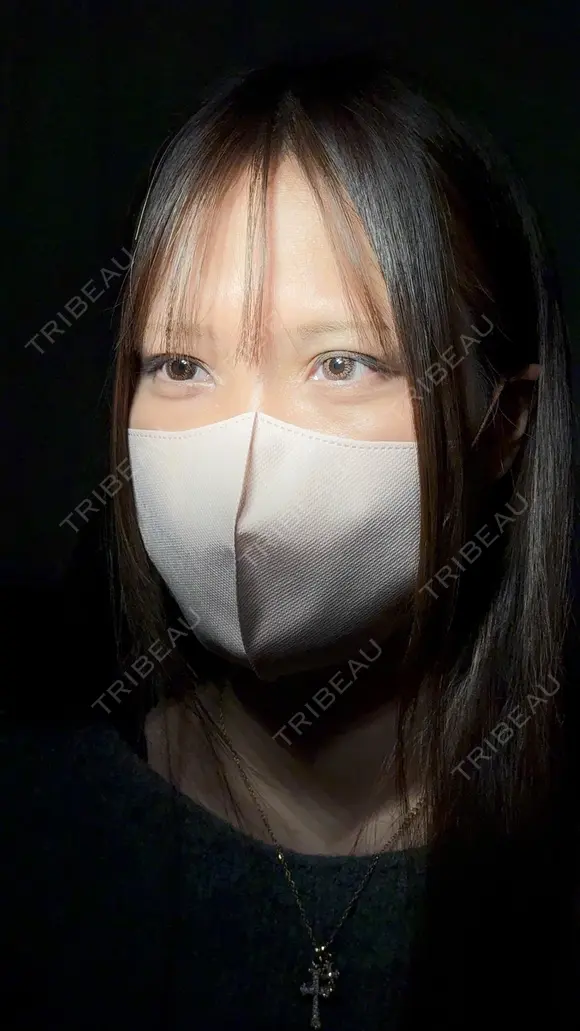 二重切開 / 目頭切開 / 上まぶたたるみ取り アリエル美容クリニック 大宮院 DAY 98 メイン用