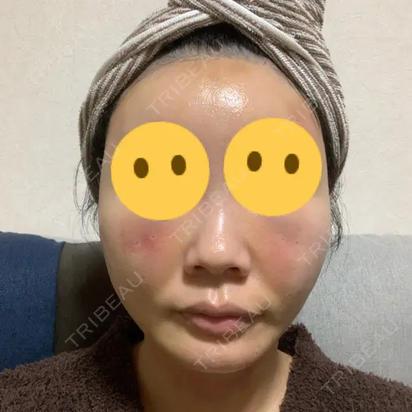 糸リフト / 脂肪吸引（顔） / 下まぶたの脂肪取り / 脂肪注入（額） / メーラーファット除去 / 脂肪注入（目の下） SEA CLINIC（シークリニック） DAY 1 メイン用