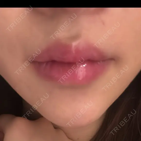 ボトックス（あご） / ボトックス（口角） ルラ美容クリニック 岐阜院 AFTER メイン用