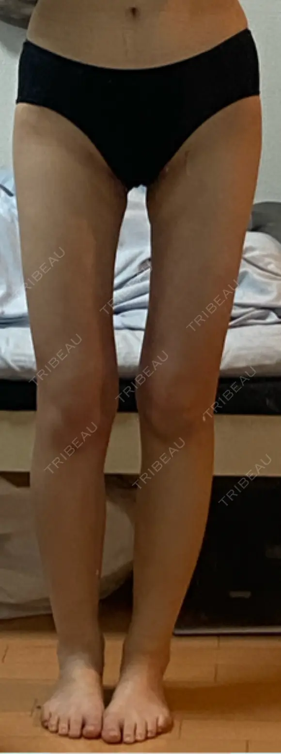 脂肪吸引（脚） / 脂肪吸引（お尻） / 脂肪溶解注射（太もも） WOM CLINIC GINZA （ワム クリニック ギンザ） DAY 25 メイン用