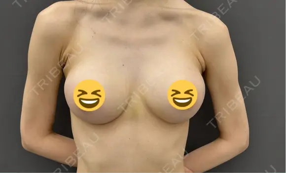 豊胸（シリコンバッグ） お茶の水美容形成クリニック AFTER メイン用