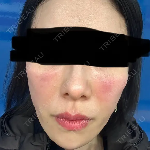 ジャルプロ ウィルビークリニック 新宿院 DAY 0 メイン用