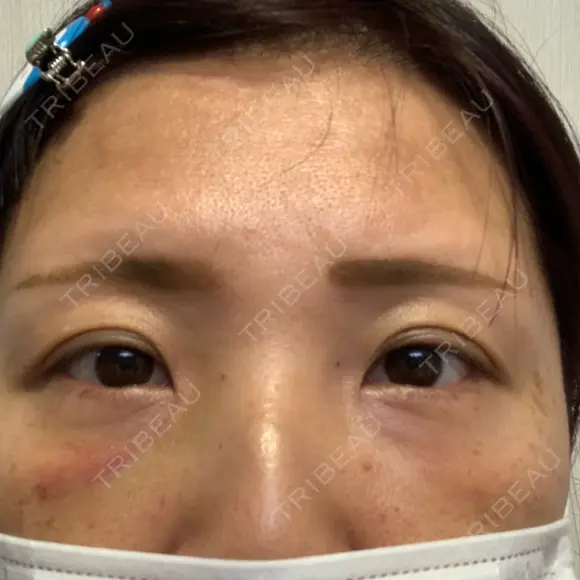 クマ治療 湘南美容クリニック 千葉センシティ院 DAY 2 メイン用