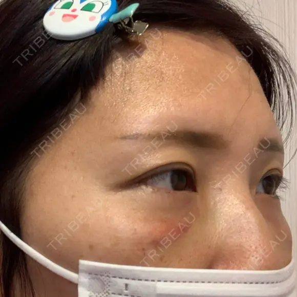 クマ治療 湘南美容クリニック 千葉センシティ院 DAY 2 メイン用