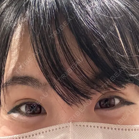 二重埋没 共立美容外科 大宮院 DAY 7 メイン用