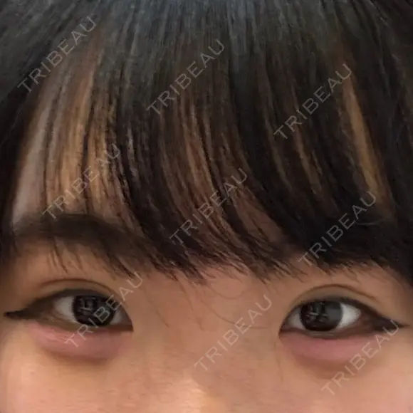二重埋没 共立美容外科 大宮院 DAY 11 メイン用