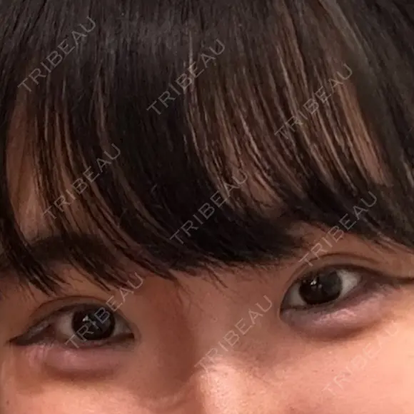 二重埋没 共立美容外科 大宮院 DAY 12 メイン用