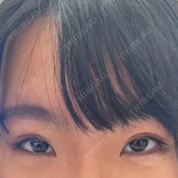 二重埋没 共立美容外科 大宮院 DAY 70 メイン用