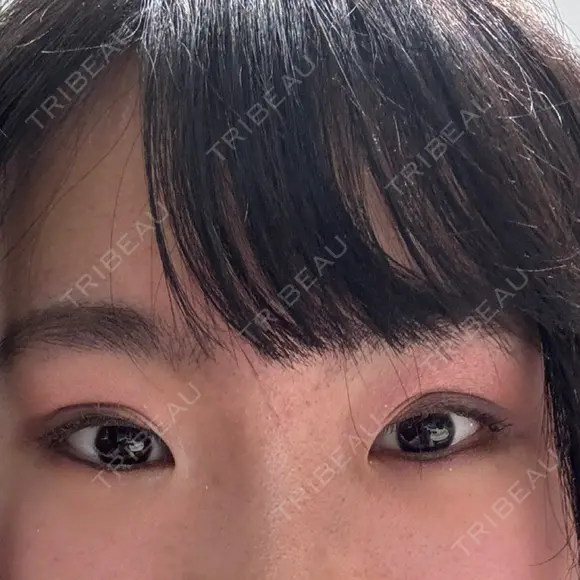 二重埋没 共立美容外科 大宮院 DAY 108 メイン用
