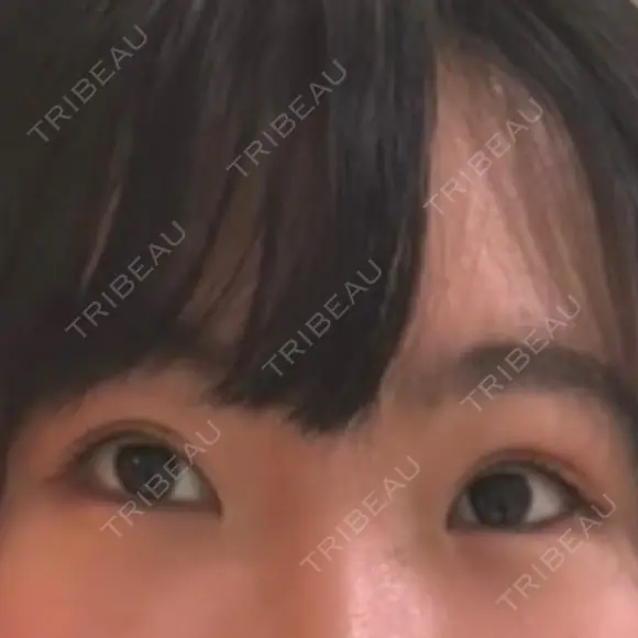 二重埋没 共立美容外科 大宮院 AFTER メイン用