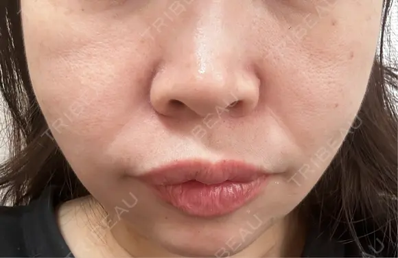 糸リフト / ボトックス（口角） 形成外科と美容外科のクリニック池袋 DAY 6 メイン用