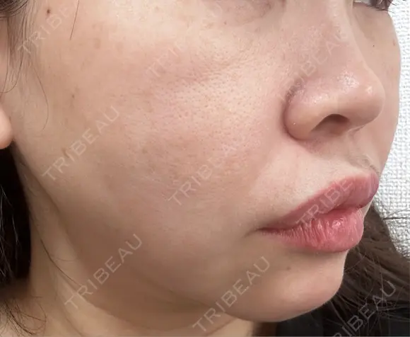 糸リフト / ボトックス（口角） 形成外科と美容外科のクリニック池袋 DAY 6 メイン用