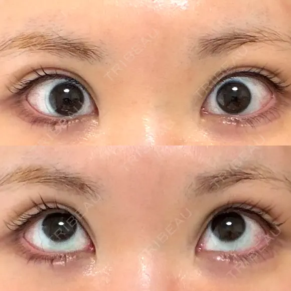 タレ目形成・グラマラスライン（切開） 形成外科と美容外科のクリニック池袋 DAY 20 メイン用