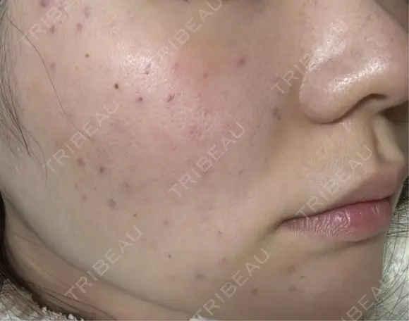 肌育注射（ジュベルックなど） 大美会クリニック 京都烏丸院 DAY 0 メイン用