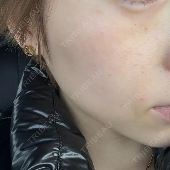 水光注射（ハリ・美肌） REVI CLINIC銀座院  AFTER メイン用