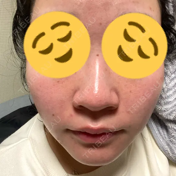 毛穴洗浄（ハイドラフェイシャルなど） / 光治療（フォトフェイシャルなど） アクティブエイジクリニック AFTER メイン用