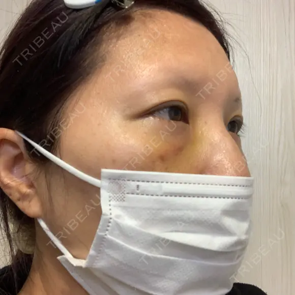 クマ治療 湘南美容クリニック 千葉センシティ院 DAY 3 メイン用
