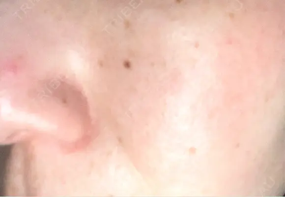 ピーリング（ニキビ・毛穴） / エレクトロポレーション / 光治療（フォトフェイシャルなど） 共立美容外科 仙台院 AFTER メイン用