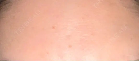 ピーリング（ニキビ・毛穴） / エレクトロポレーション / 光治療（フォトフェイシャルなど） 共立美容外科 仙台院 DAY 7 メイン用