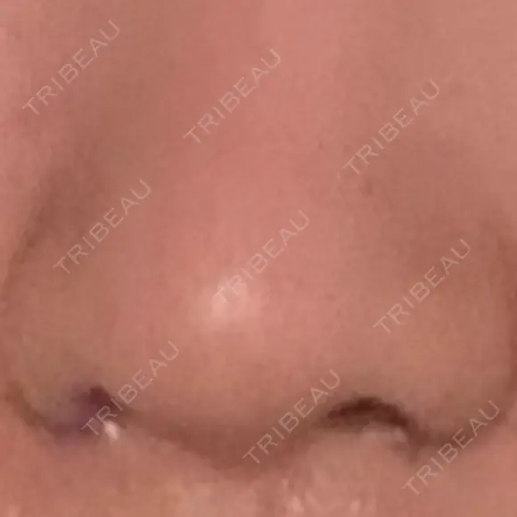 小鼻縮小（切開） EMMO FACE CLINIC 東京三田院 AFTER メイン用