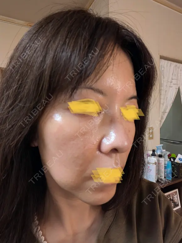 毛穴洗浄（ハイドラフェイシャルなど） Zetith Beauty Clinic 池袋院 DAY 2 メイン用