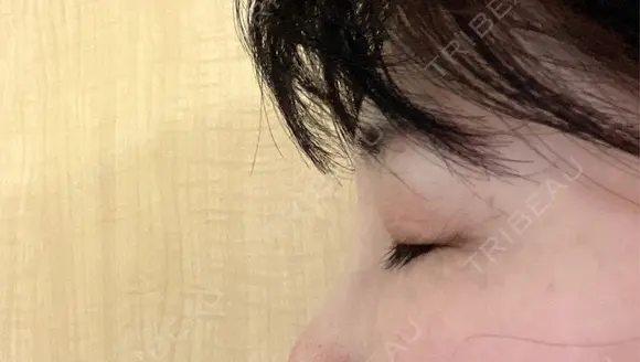 ヒアルロン酸注入（目の下） DMTC CLINIC 渋谷院 AFTER メイン用