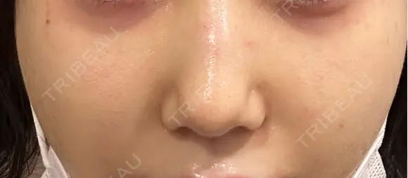 ポテンツァ エトワールレジーナクリニック新宿院 AFTER メイン用