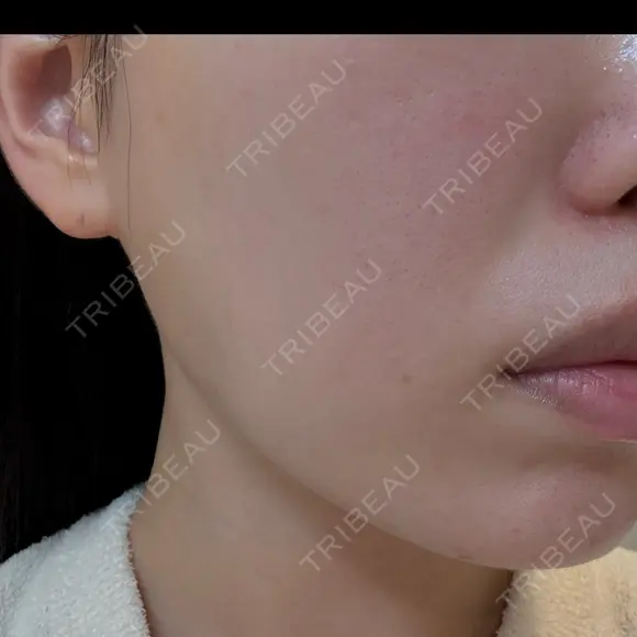 ピーリング（ハリ・ツヤ） / ルメッカ 大美会クリニック 梅田院 AFTER メイン用