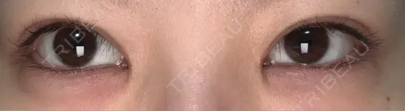 ヒアルロン酸注入（涙袋） 吉祥寺アイビークリニック DAY 4 メイン用