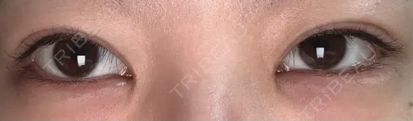 ヒアルロン酸注入（涙袋） 吉祥寺アイビークリニック DAY 5 メイン用