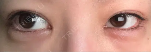 ヒアルロン酸注入（涙袋） 吉祥寺アイビークリニック DAY 6 メイン用