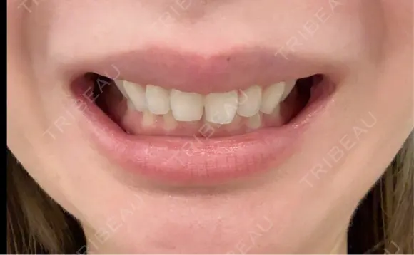 ボトックス（口角） BON BON CLINIC 渋谷院 AFTER メイン用