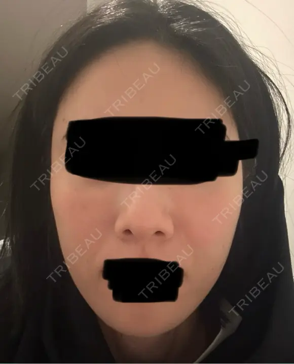 ジャルプロ ウィルビークリニック 新宿院 AFTER メイン用