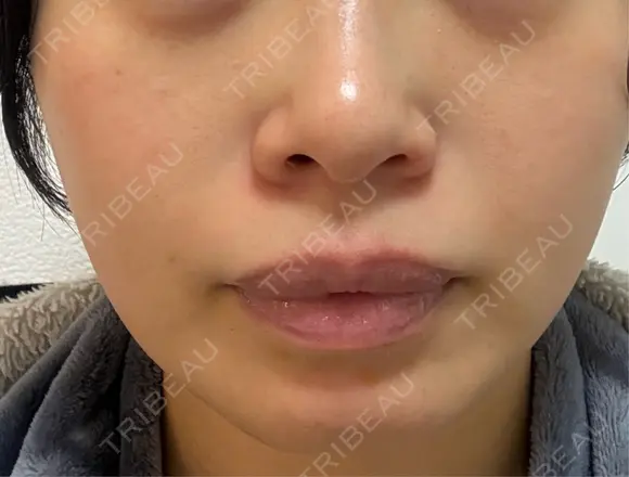 光治療（フォトフェイシャルなど） 品川美容外科 渋谷院（※品川スキンクリニック提携） AFTER メイン用